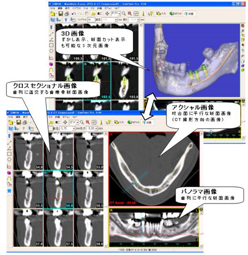 SimPlant®（シムプラント）－インプラント術前シミュレーション